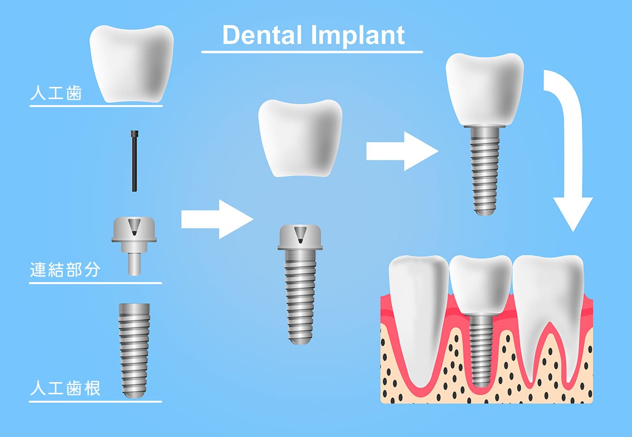 インプラントの構造